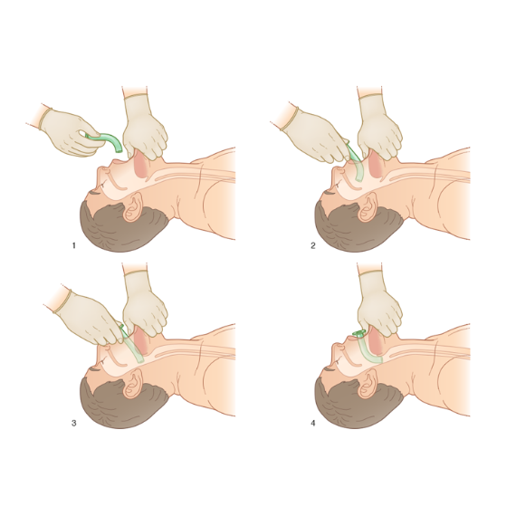 Svelgtube nr 0,1,2,3,4 (Pakke)